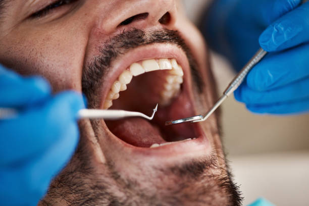 Best Emergency Tooth Extraction in Forest Ranch, CA