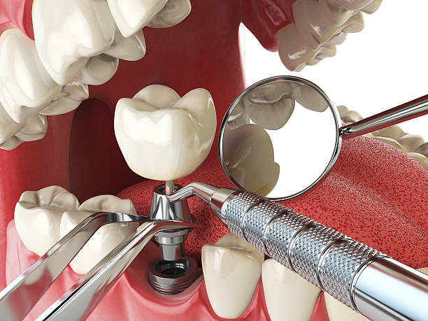 Best Emergency Tooth Extraction in Forest Ranch, CA